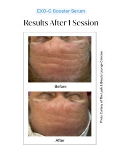 Exosome Infusion Serum Before & After Front View